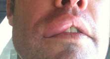 Commerce Bee Removal Guy Anthony picture of swelling after being stung 
    on the lip.